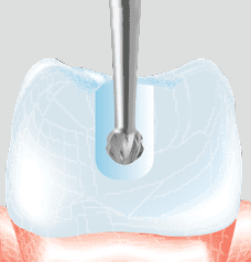Endo Access on Natural Teeth